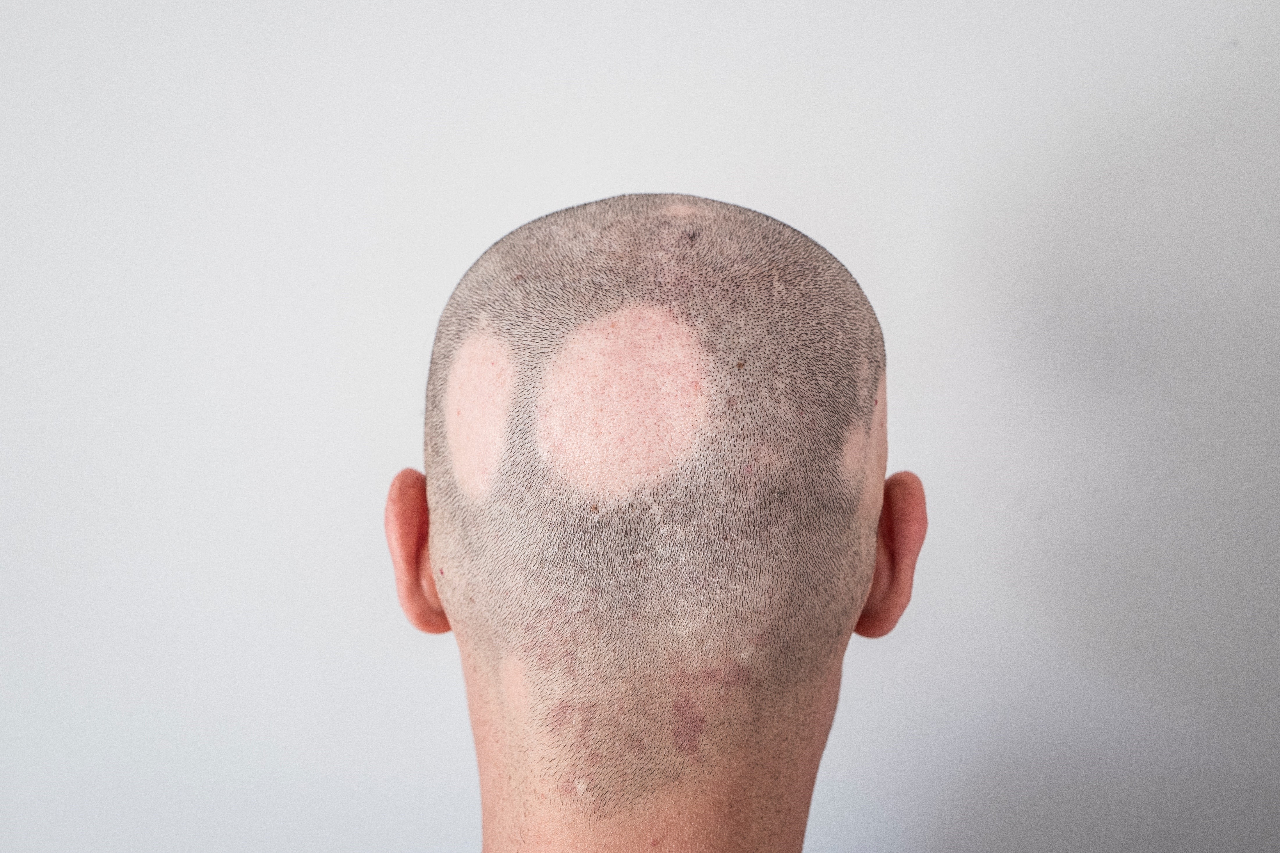 Alopecia Areata.jpg