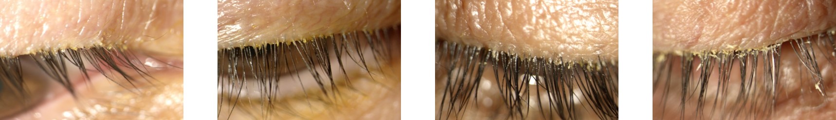 Figure 2 Eyelids with Blepharitis.jpg