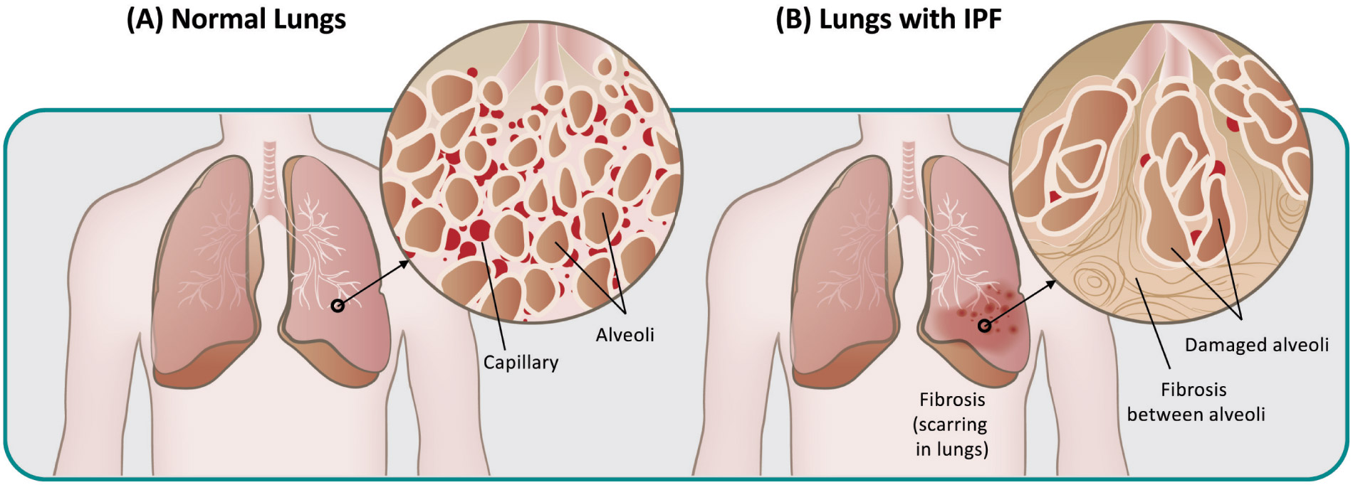 [MISSING IMAGE: tm225197d6-pht_lungs4c.jpg]